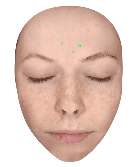 pimple Scars