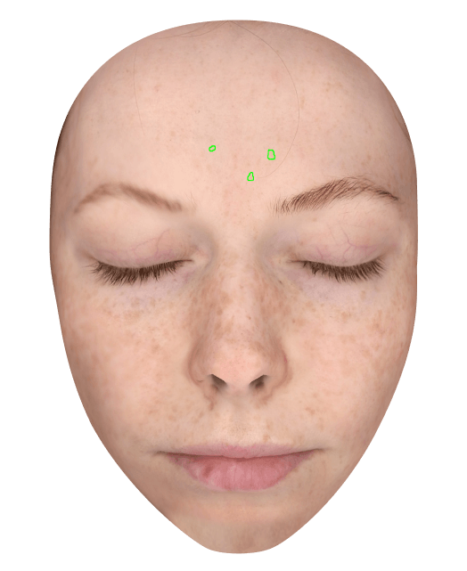 Acne Scars